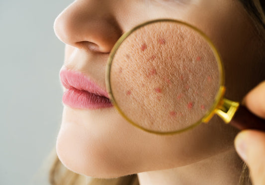 close up image of a woman with acne prone skin and some blemishes on her face, and a magnifying glass looking at the blemishes. 