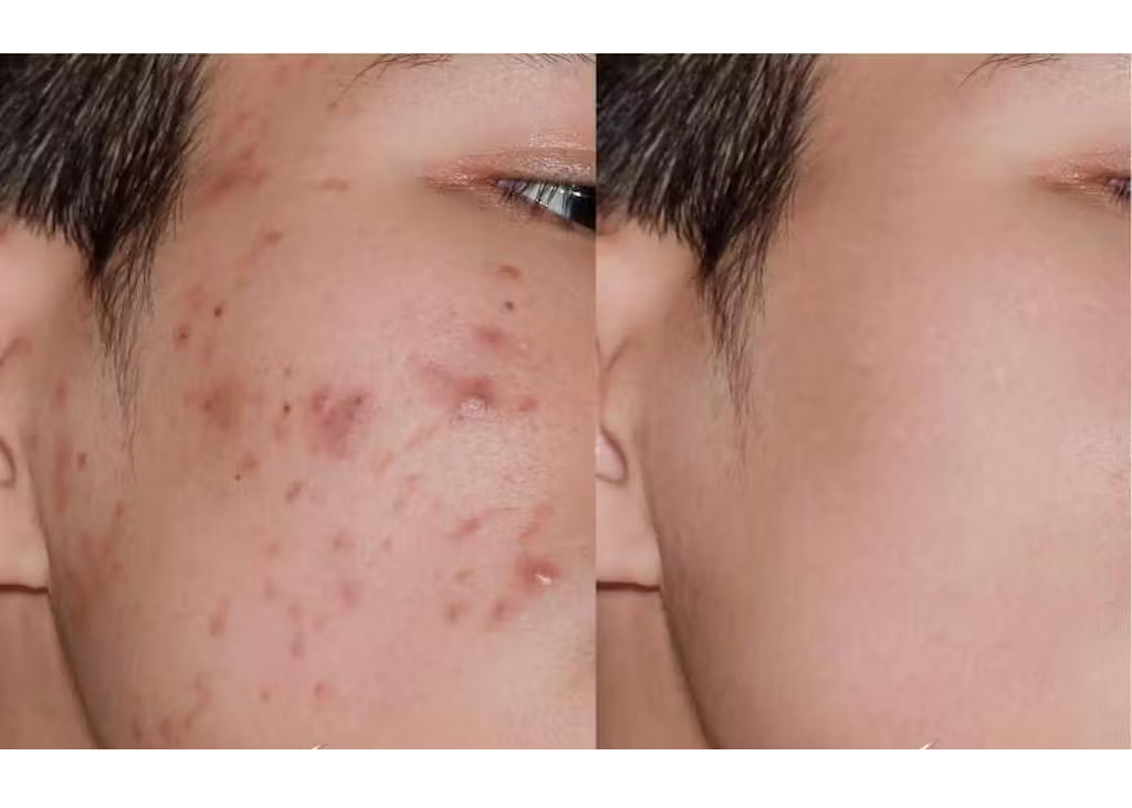 Acne Spot Care