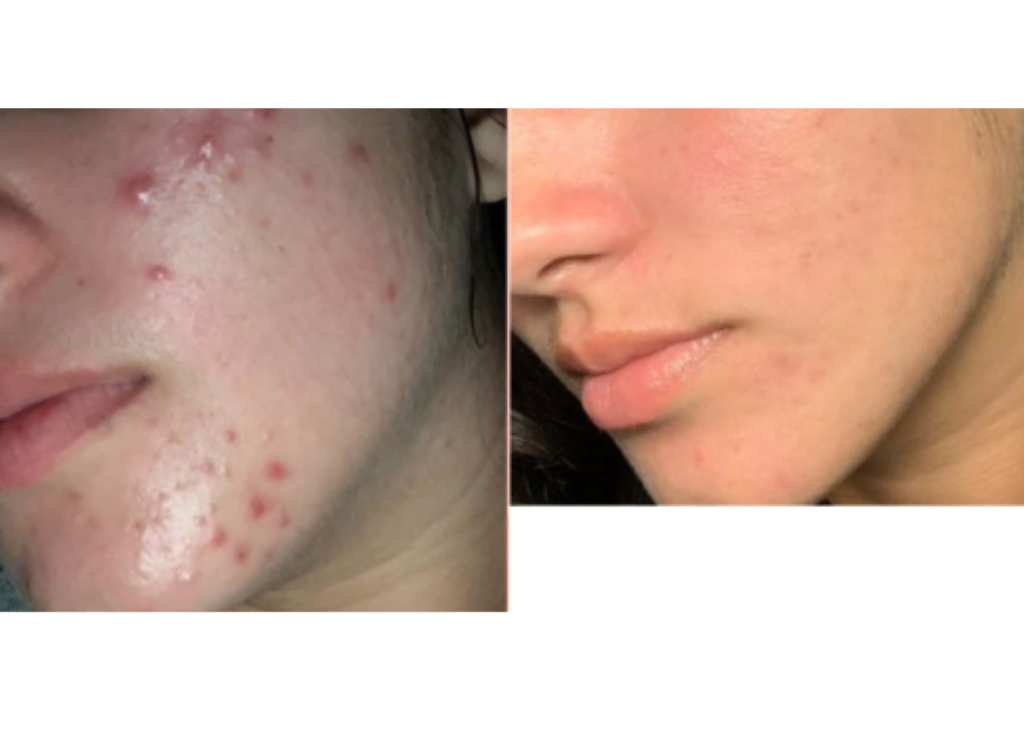 Acne Spot Care