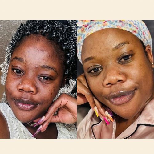 Acne Spot Care